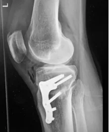 Postoperative 3 months